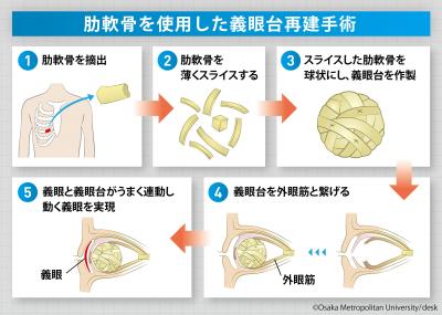 医学部TRENDY Vol.05　眼が自然に動く！ 義眼手術の最新技術とは 形成外科学 元村 尚嗣 教授 （医学部広報委員長）