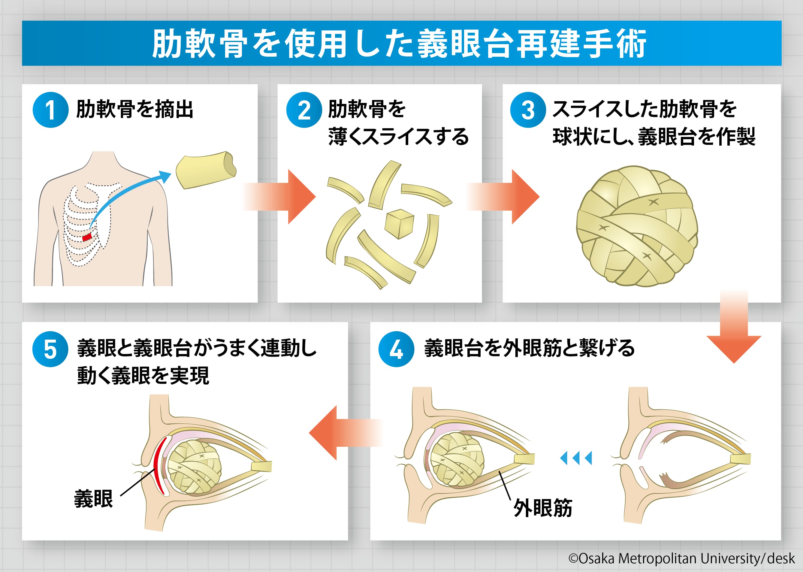 肋軟骨を使用した義眼台再建手術を表した図