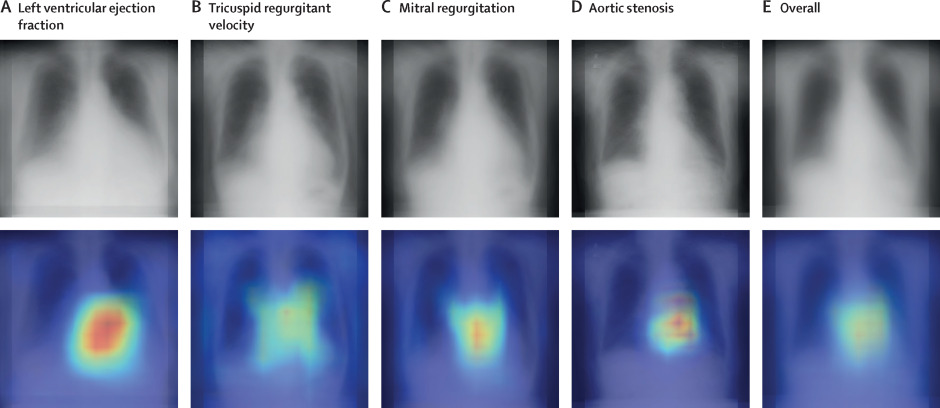 Multi-Institutional Collaborative Research on AI for Estimating Cardiac Function and Valvular Disease from Chest X-rays