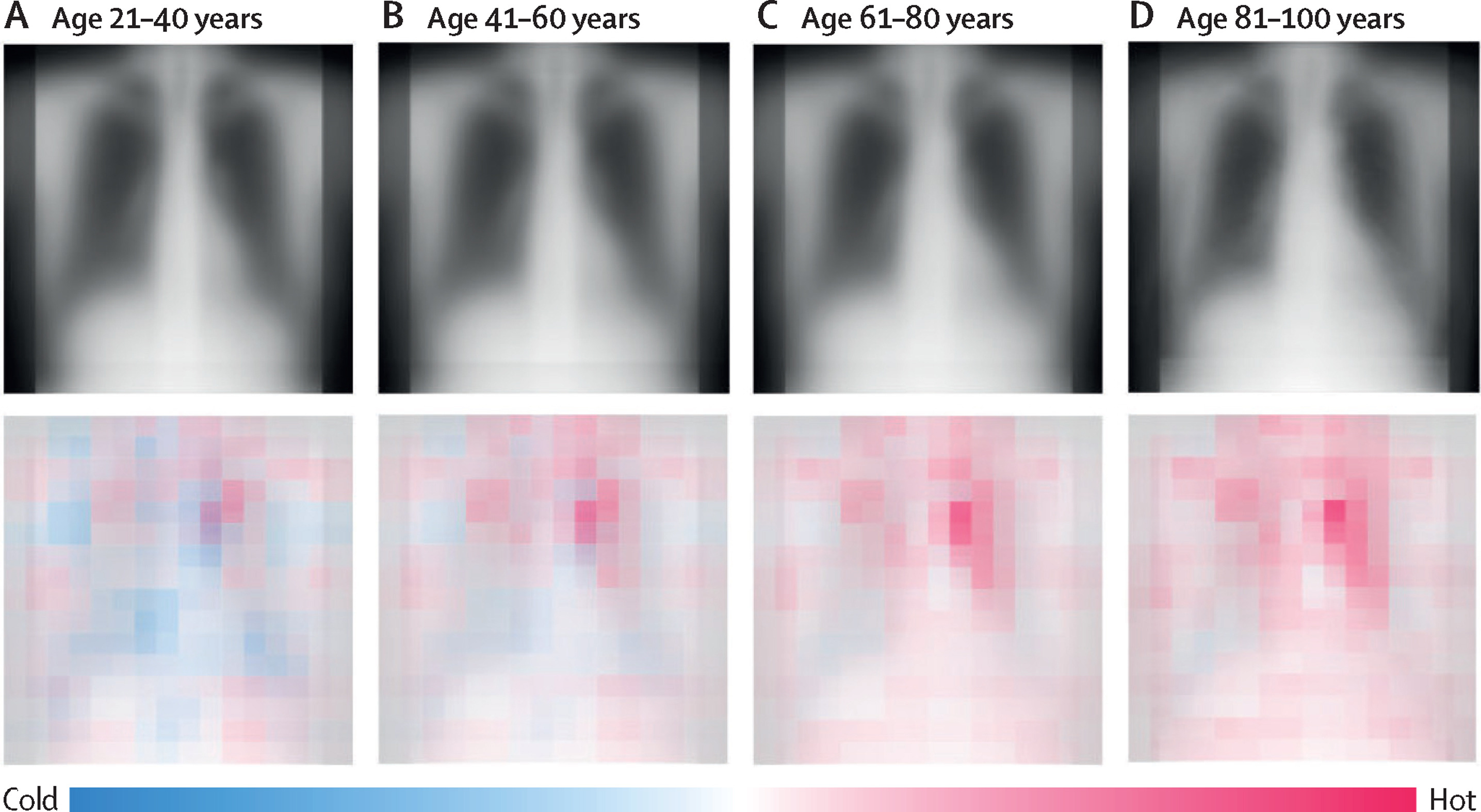 Clinical Application of Aging Biomarker Developed from Chest X-rays of Healthy Individuals
