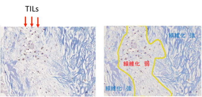 Colorectal-CancerT-01