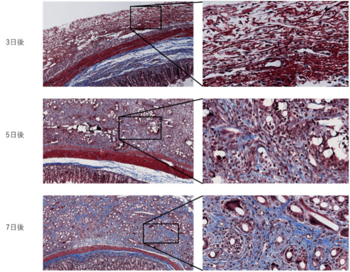 Colorectal-CancerT-02