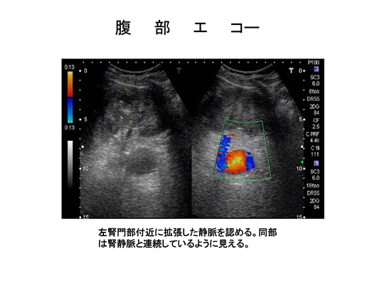 バッドキアリ症候群のエコー像