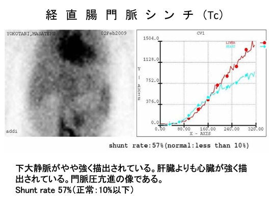 バッドキアリ症候群のエコー像