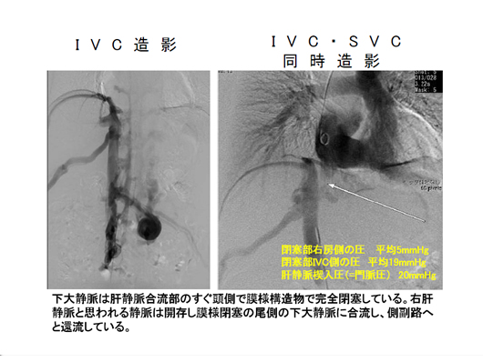 バッドキアリ症候群のエコー像