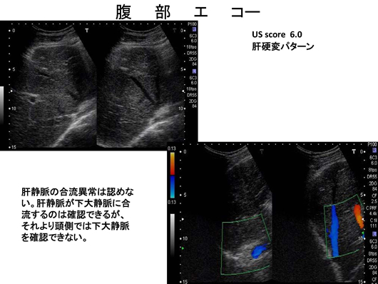 バッドキアリ症候群のエコー像