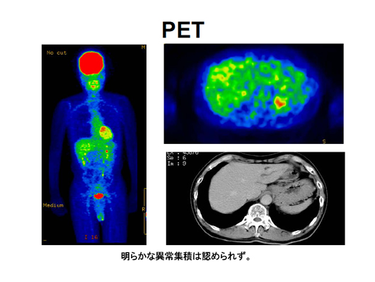 造影エコーで病変の存在が明らかとなった肝内胆管癌の一例
