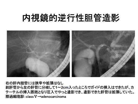 造影エコーで病変の存在が明らかとなった肝内胆管癌の一例
