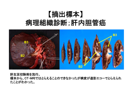 造影エコーで病変の存在が明らかとなった肝内胆管癌の一例