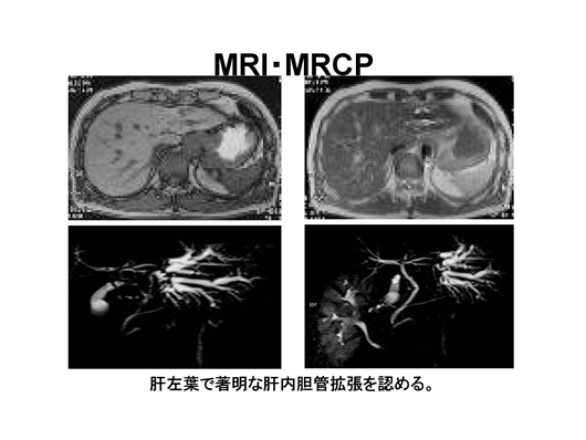 造影エコーで病変の存在が明らかとなった肝内胆管癌の一例