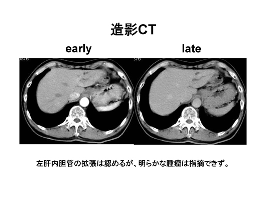 造影エコーで病変の存在が明らかとなった肝内胆管癌の一例