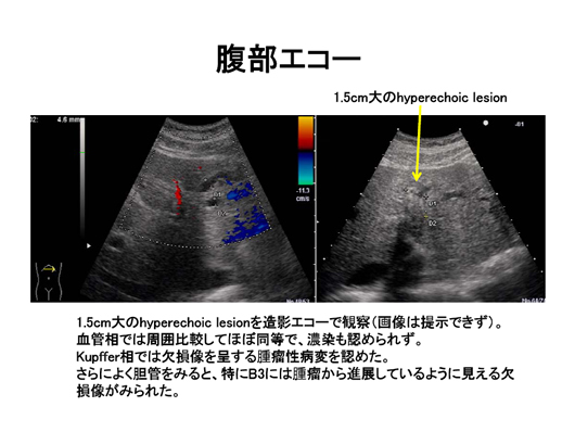 造影エコーで病変の存在が明らかとなった肝内胆管癌の一例