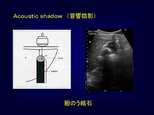 腹部超音波の用語