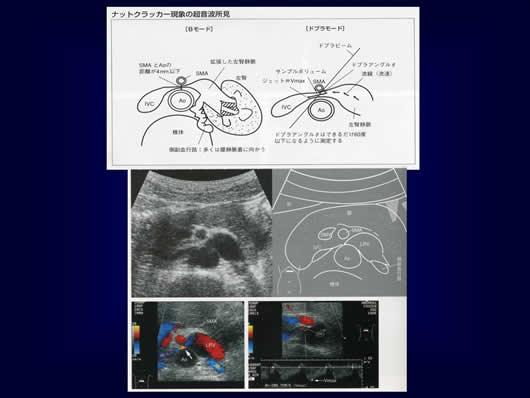 腹部超音波の用語