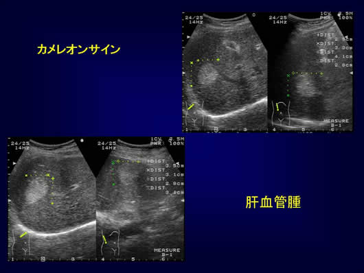 腹部超音波の用語