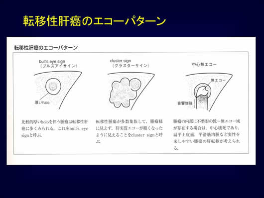 腹部超音波の用語