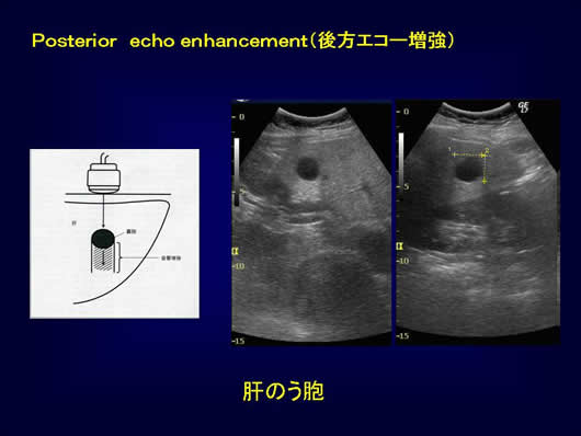 腹部超音波の用語