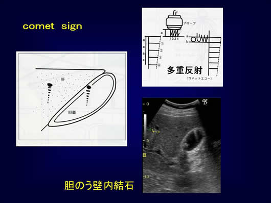 腹部超音波の用語