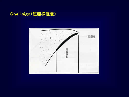 腹部超音波の用語