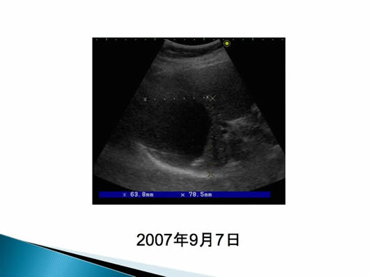 肝のう胞内出血が疑われた2例