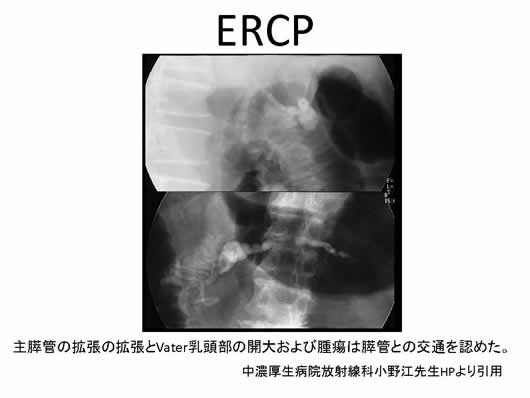 膵臓の描出のコツ、みかた、MPD拡張