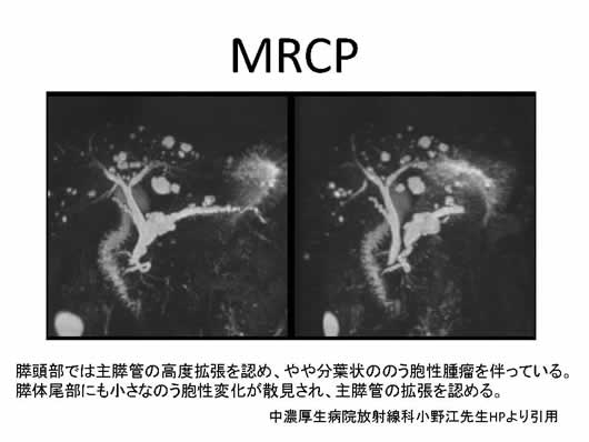 膵臓の描出のコツ、みかた、MPD拡張