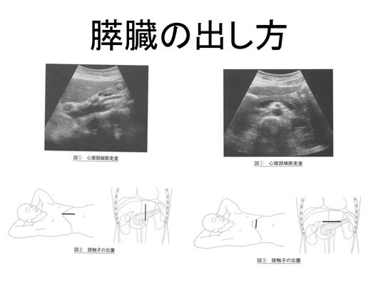 膵臓の描出のコツ、みかた、MPD拡張