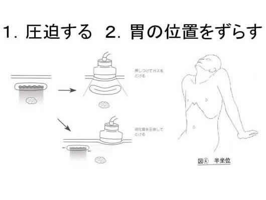 膵臓の描出のコツ、みかた、MPD拡張