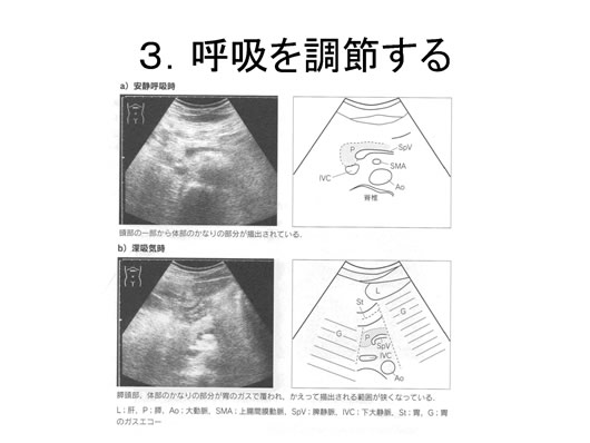 膵臓の描出のコツ、みかた、MPD拡張