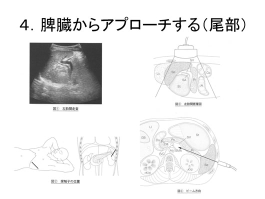 膵臓の描出のコツ、みかた、MPD拡張