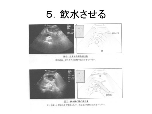 膵臓の描出のコツ、みかた、MPD拡張