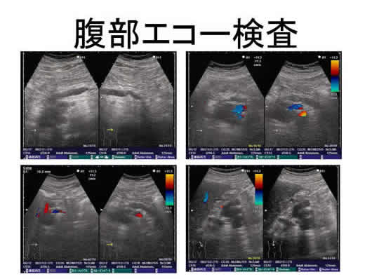 膵臓の描出のコツ、みかた、MPD拡張