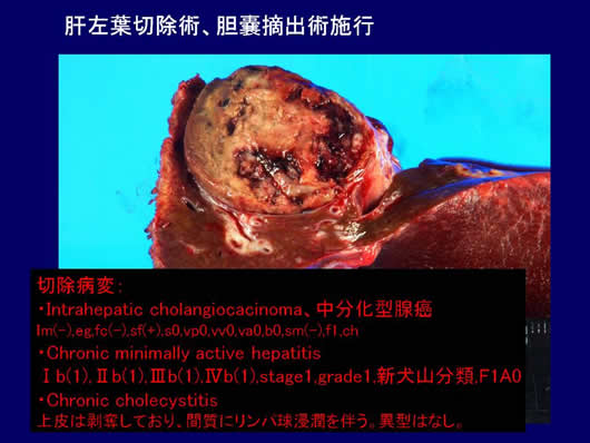 診断に難渋した肝腫瘍の1例