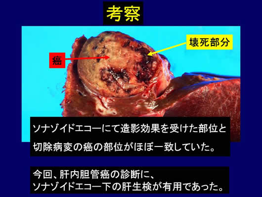 診断に難渋した肝腫瘍の1例