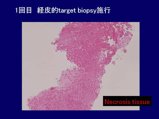 診断に難渋した肝腫瘍の1例