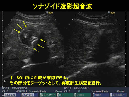 診断に難渋した肝腫瘍の1例