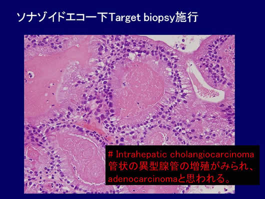 診断に難渋した肝腫瘍の1例