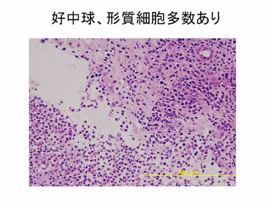 肝内多発SOLの1例