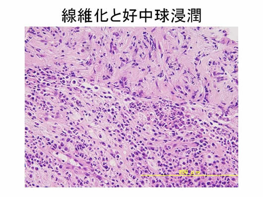 肝内多発SOLの1例