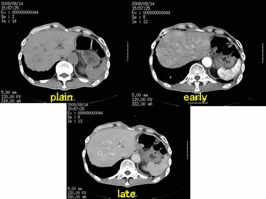 肝内多発SOLの1例
