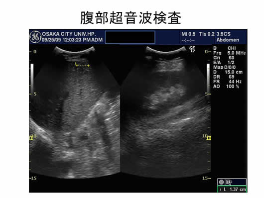 肝内多発SOLの1例