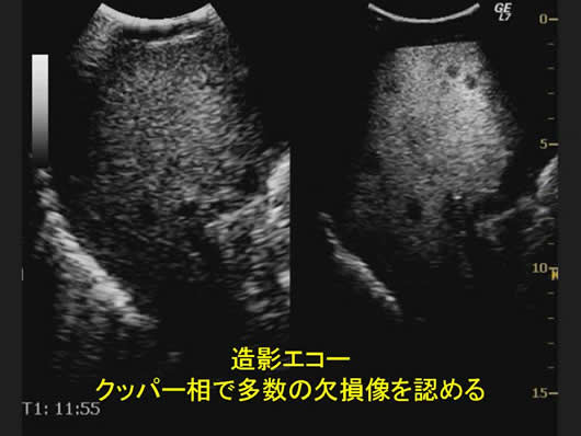 肝内多発SOLの1例