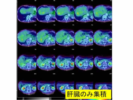 肝内多発SOLの1例