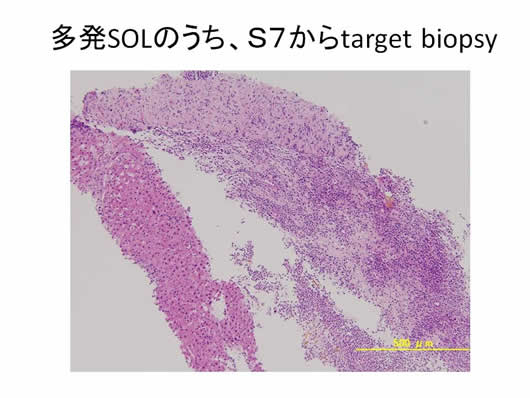 肝内多発SOLの1例