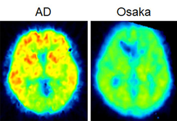 図5.Osaka変異患者のアミロイド・イメージング