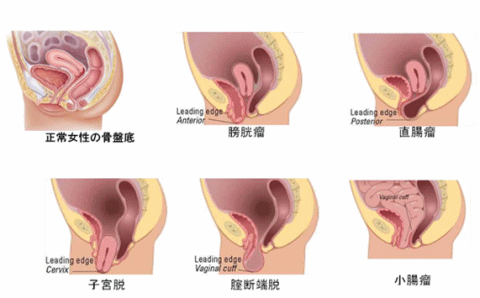 骨盤臓器脱