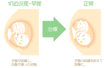 切迫流産イラスト