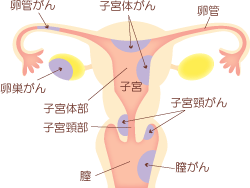 子宮頸がんイラスト