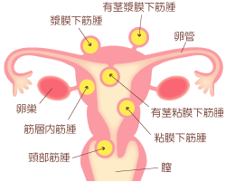 子宮筋腫イラスト