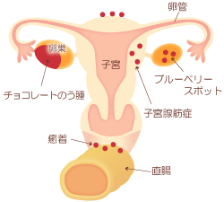 子宮内膜症イラスト